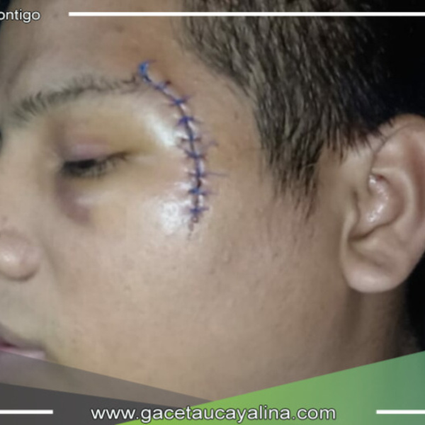 Joven de 22 años queda con el rostro desfigurado tras ser atacado con una botella en Loreto