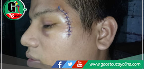 Joven de 22 años queda con el rostro desfigurado tras ser atacado con una botella en Loreto