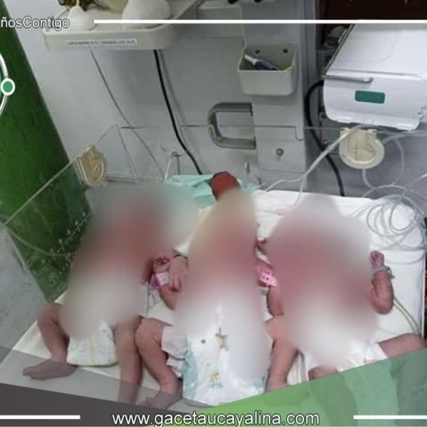 Nacen trillizos en Hospital Iquitos: Un logro médico y humano 
