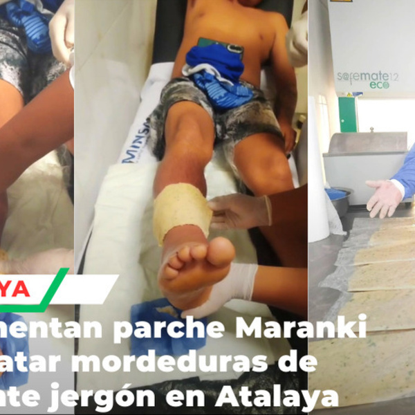 Hospital de Atalaya implementa parche ancestral contra mordedura de jergón
