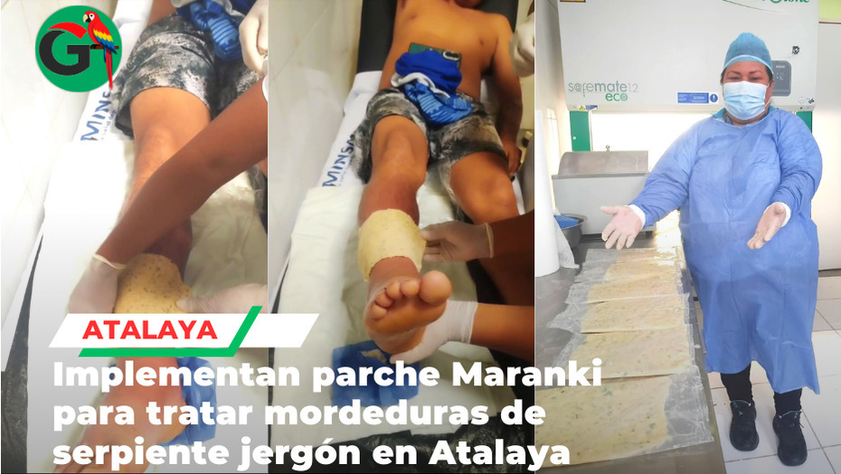 Hospital de Atalaya implementa parche ancestral contra mordedura de jergón